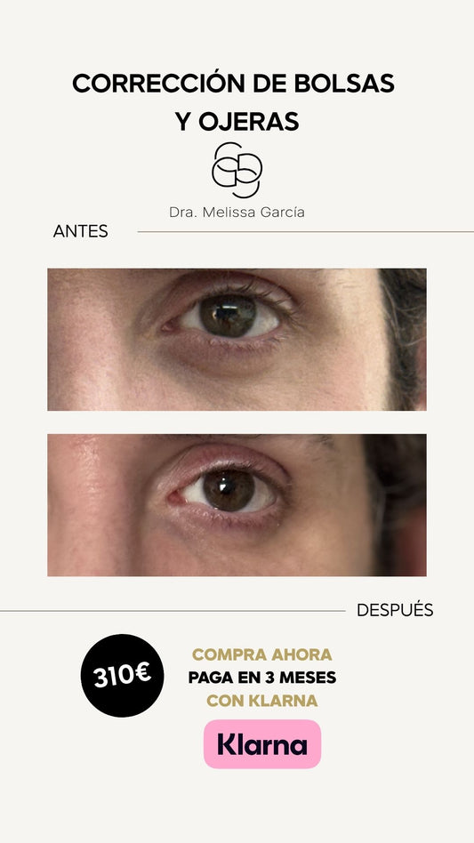 Elimina ojeras con ácido hialurónico - 1ml