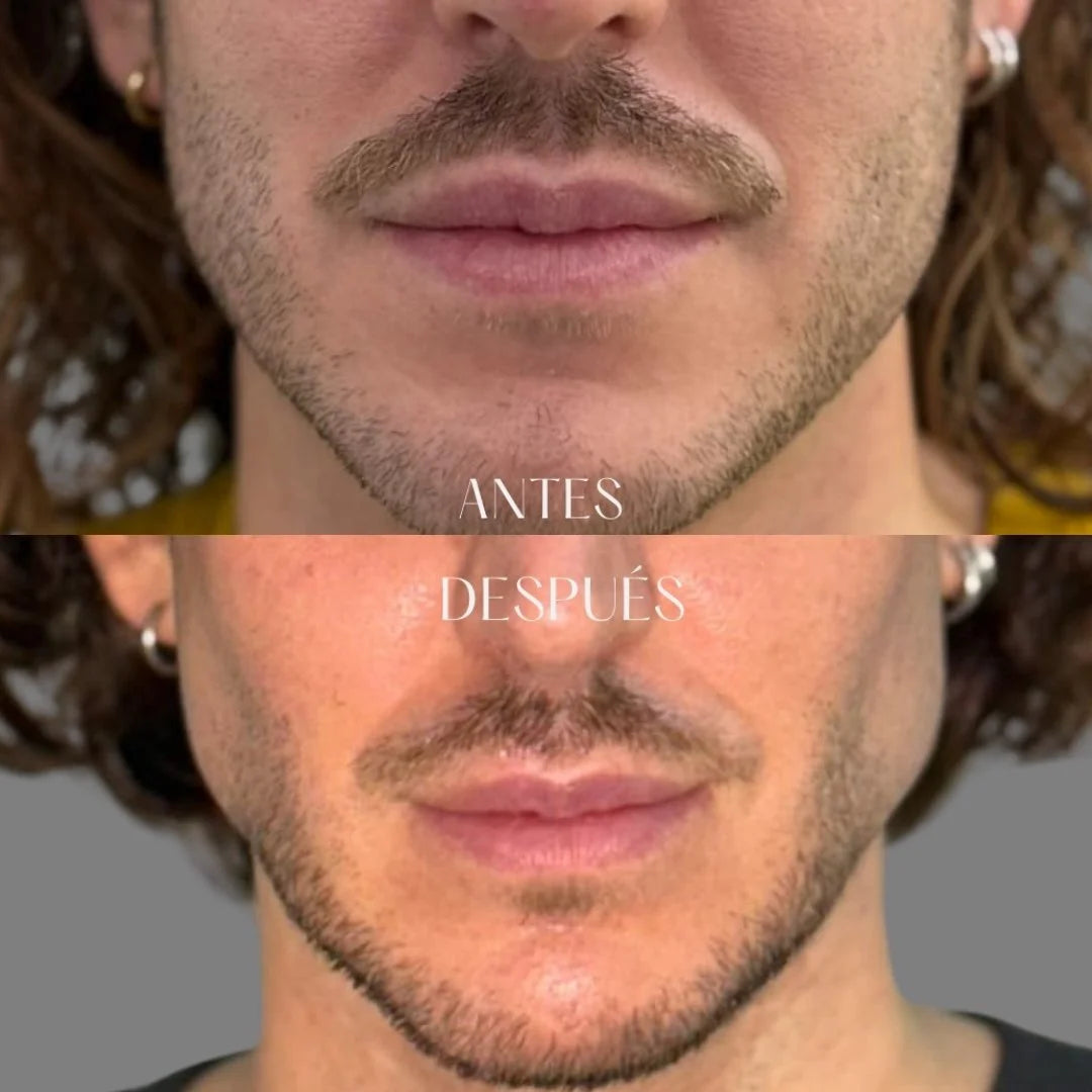 Masculinización facial - 5 ML